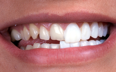 Porcelain Veneers